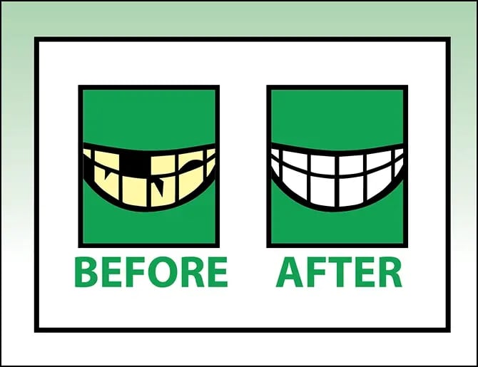 a before-and-after image showing a mouth full of damaged teeth before and a mouth full of visually appealing implants after